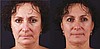 EXilis  - lifting twarzy, szyi, dekoltu i biustu